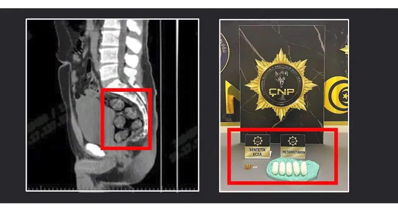 Tomografide şok eden görüntü