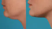 Estetik Yok, Masraf Yok! Sarkık Gıdıyı 10 Günde Toparlayan 3 Egzersiz
