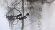 Felç riskine karşı ameliyatsız çözüm
