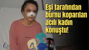 Eşi tarafından burnu koparılan acılı kadın konuştu!