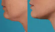 Estetik Yok, Masraf Yok! Sarkık Gıdıyı 10 Günde Toparlayan 3 Egzersiz