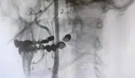 Felç riskine karşı ameliyatsız çözüm
