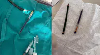 Genç kadının midesinden 2 tane kalem çıkartıldı