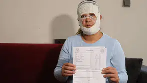 Güzelleşmek uğruna gittiği merkezde yüzü yandı