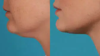 Estetik Yok, Masraf Yok! Sarkık Gıdıyı 10 Günde Toparlayan 3 Egzersiz