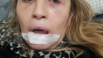Güzelleşmek isterken dudağından oldu
