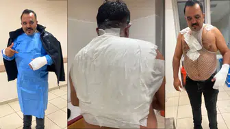 Akım yapayım derken kendini yaktı