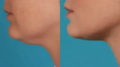 Estetik Yok, Masraf Yok! Sarkık Gıdıyı 10 Günde Toparlayan 3 Egzersiz