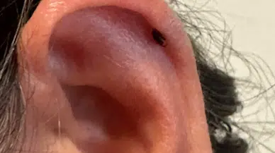 Bir kene vakası daha: Kadını kulağından ıssırmış