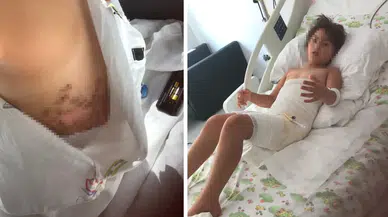 Düğünde kız çocuğunun üstüne sıvı azot döküldü