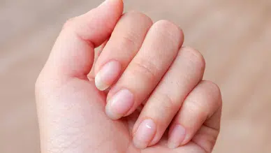 Tırnakta Beyaz Leke Neden Olur? Uzmanlar Açıkladı, Ciddiye Alınmalı!