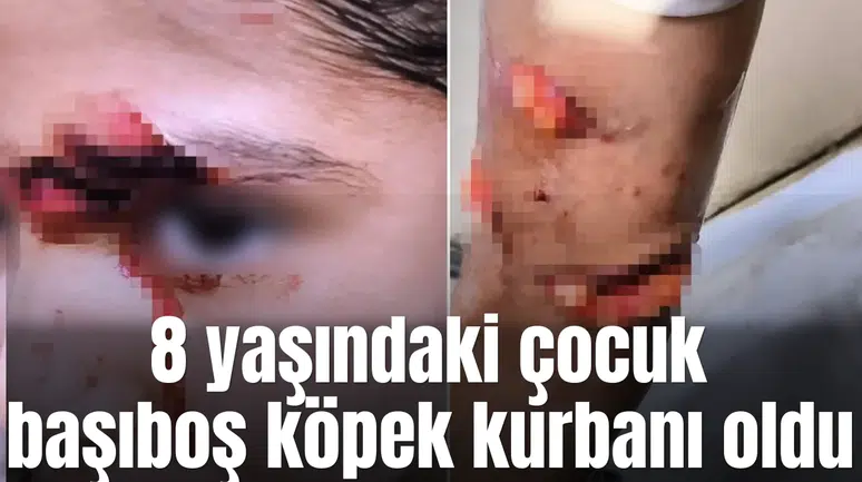 8 yaşındaki çocuk başıboş köpek kurbanı oldu