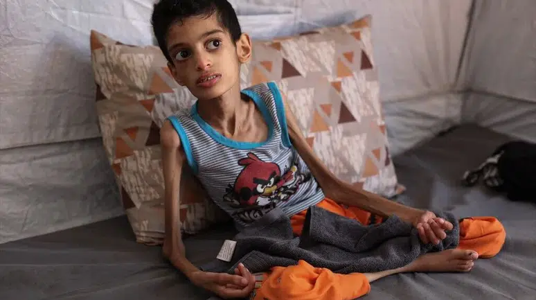 16 yaşındaki Gazzeli İbrahim 7,5 kiloya düştü