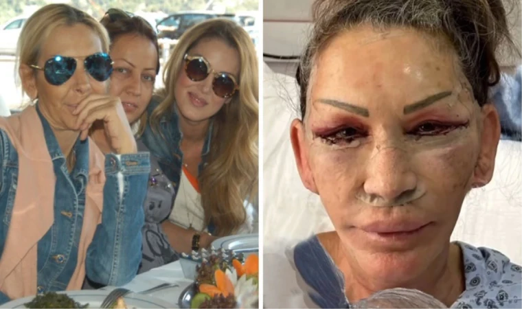 Petek Dinçöz'ün annesi yüz gerdirme ameliyatı oldu!