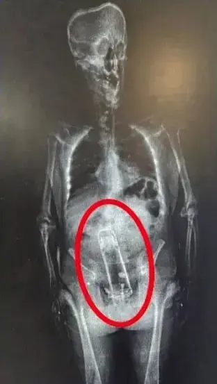 Hapishane girişinde yapılan taramada ortaya çıkan gerçek polisleri dumura uğrattı